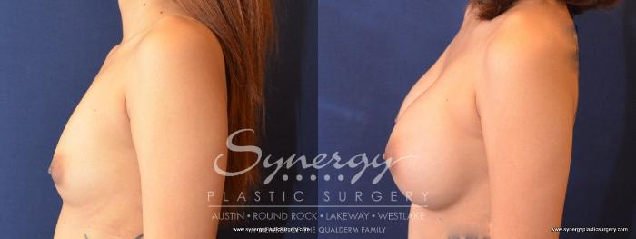 Before & After Breast Augmentation Case 480 View #3 View in Austin, TX