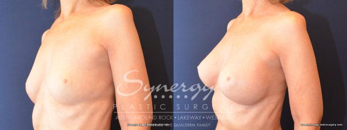 Before & After Breast Augmentation Case 486 View #2 View in Austin, TX