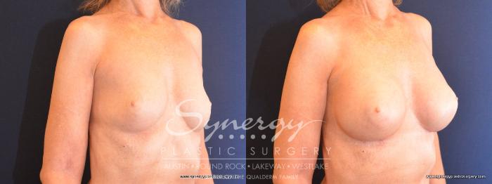 Before & After Breast Augmentation Case 486 View #4 View in Austin, TX
