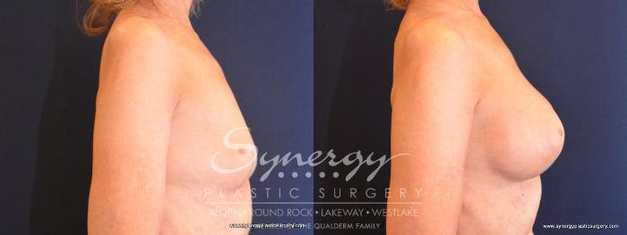 Before & After Breast Augmentation Case 486 View #5 View in Austin, TX