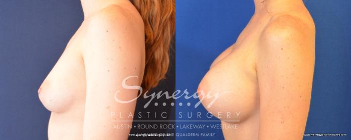 Before & After Breast Augmentation Case 492 View #3 View in Austin, TX