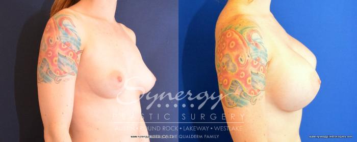 Before & After Breast Augmentation Case 492 View #4 View in Austin, TX