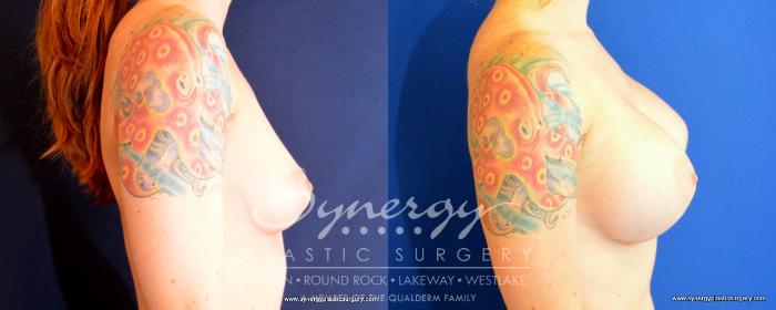 Before & After Breast Augmentation Case 492 View #5 View in Austin, TX