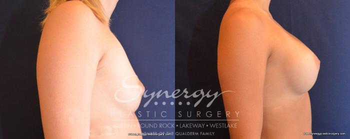 Before & After Breast Augmentation Case 494 View #3 View in Austin, TX