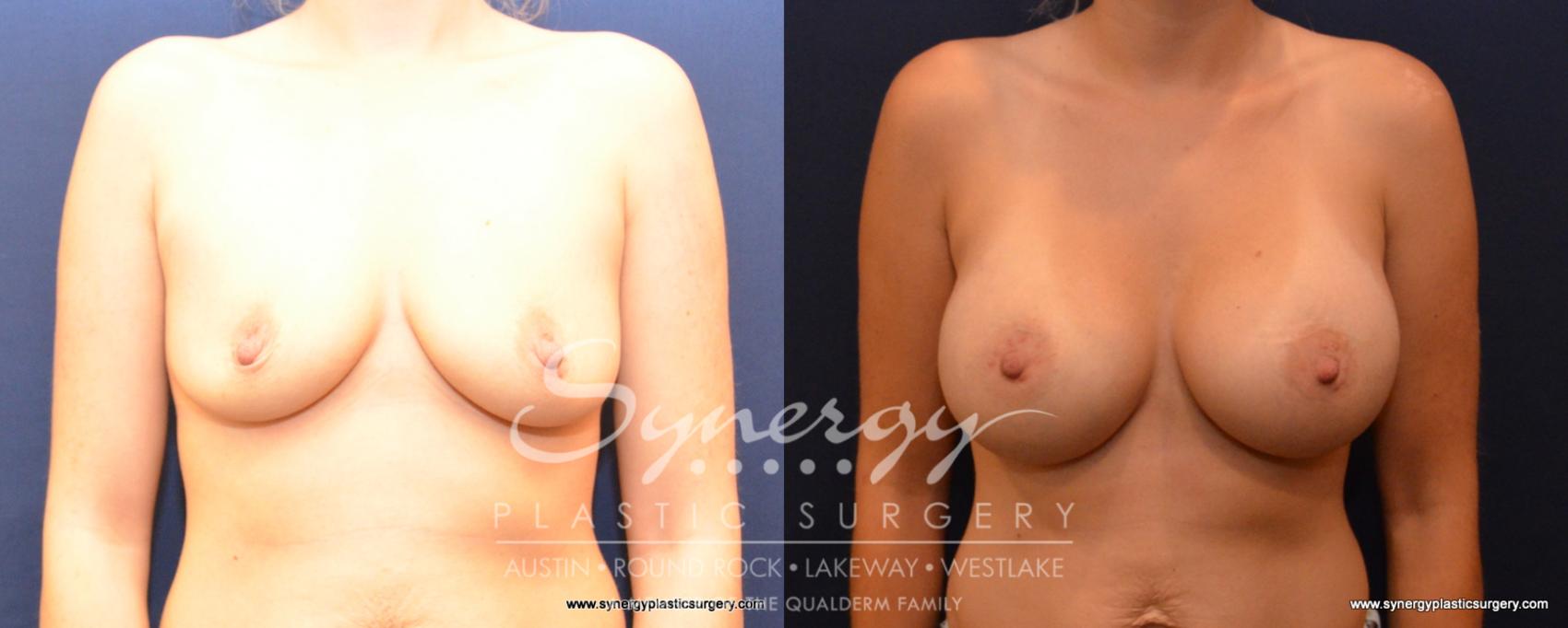 Before & After Breast Augmentation Case 500 View #1 View in Austin, TX
