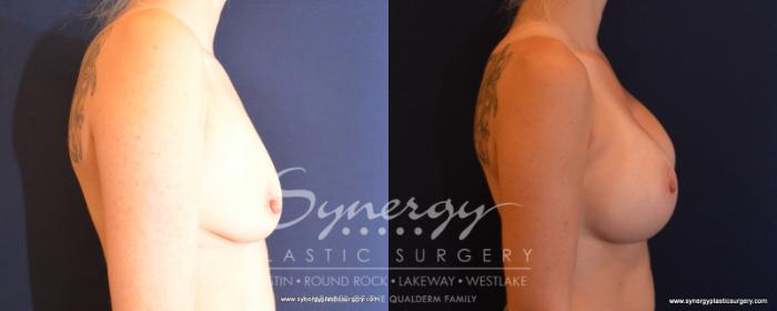 Before & After Breast Augmentation Case 500 View #5 View in Austin, TX