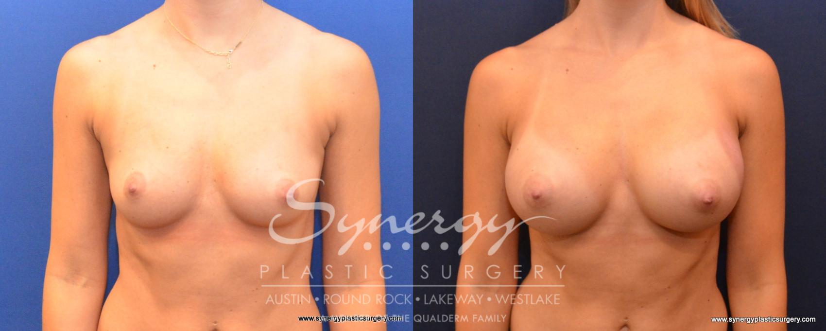 Before & After Breast Augmentation Case 502 View #1 View in Austin, TX