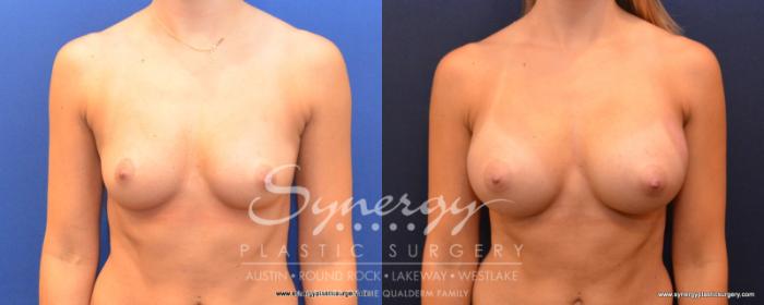 Before & After Breast Augmentation Case 502 View #1 View in Austin, TX