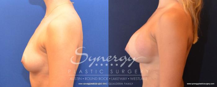 Before & After Breast Augmentation Case 502 View #3 View in Austin, TX