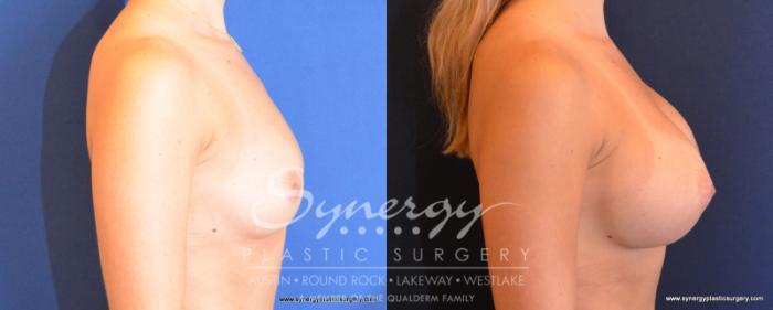 Before & After Breast Augmentation Case 502 View #5 View in Austin, TX