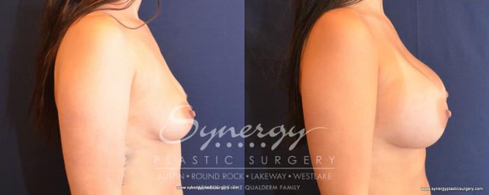 Before & After  Case 504 View #4 View in Austin, TX