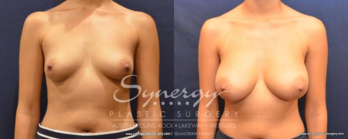 Before & After Breast Augmentation Case 506 View #1 View in Austin, TX