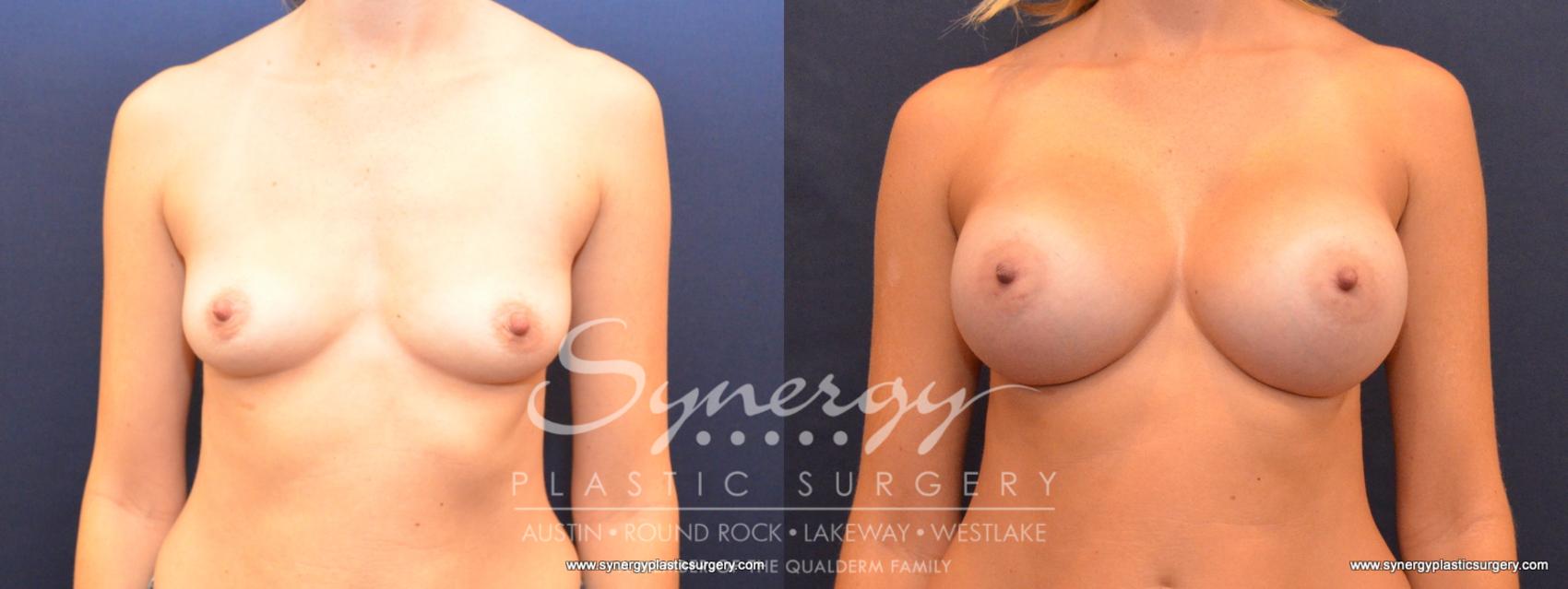 Before & After Breast Augmentation Case 512 View #1 View in Austin, TX