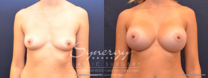 Before & After Breast Augmentation Case 512 View #1 View in Austin, TX
