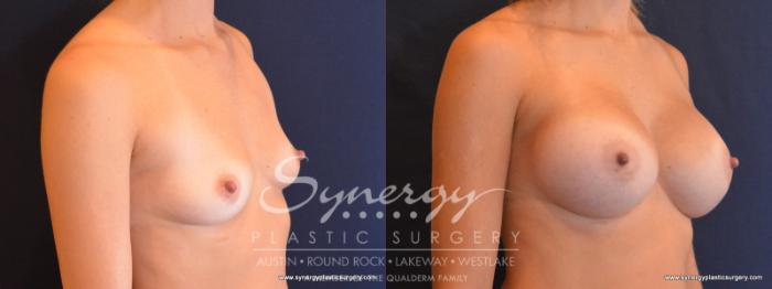 Before & After Breast Augmentation Case 512 View #4 View in Austin, TX