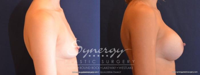 Before & After Breast Augmentation Case 512 View #5 View in Austin, TX