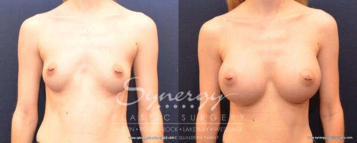 Before & After Breast Augmentation Case 513 View #1 View in Austin, TX