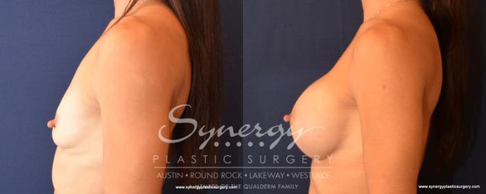 Before & After Breast Augmentation Case 519 View #3 View in Austin, TX