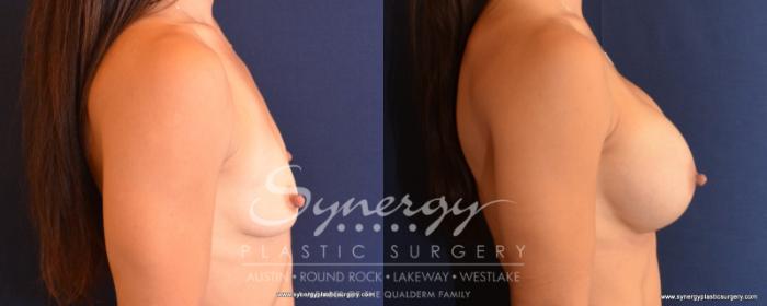 Before & After Breast Augmentation Case 519 View #5 View in Austin, TX