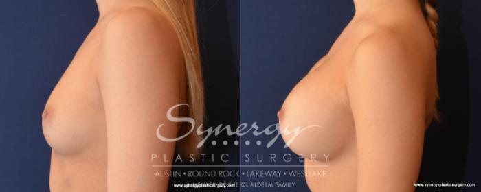 Before & After Breast Augmentation Case 523 View #2 View in Austin, TX