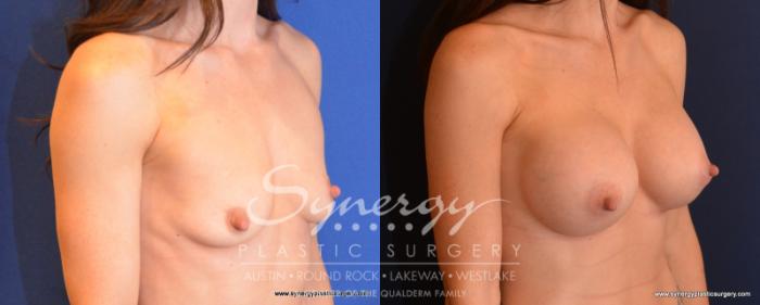 Before & After Breast Augmentation Case 529 View #2 View in Austin, TX
