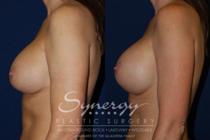 Before & After Breast Augmentation Case 53 View #4 View in Austin, TX
