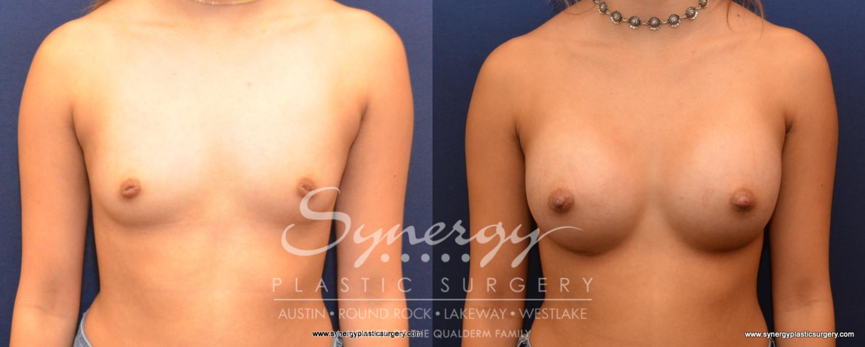 Before & After Breast Augmentation Case 531 View #1 View in Austin, TX