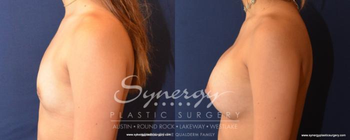 Before & After Breast Augmentation Case 531 View #3 View in Austin, TX