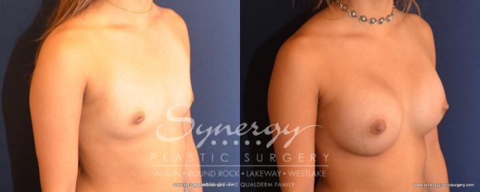 Before & After Breast Augmentation Case 531 View #4 View in Austin, TX