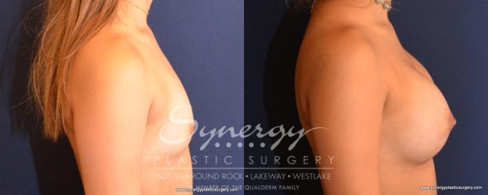Before & After Breast Augmentation Case 531 View #5 View in Austin, TX