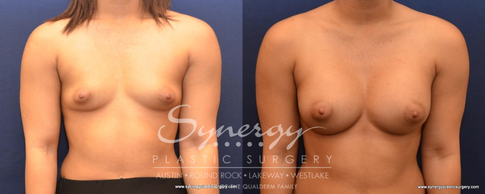 Before & After Breast Augmentation Case 532 View #1 View in Austin, TX