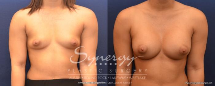 Before & After Breast Augmentation Case 532 View #1 View in Austin, TX