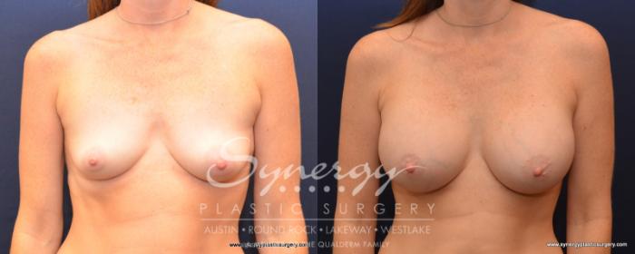 Before & After Breast Augmentation Case 534 View #1 View in Austin, TX