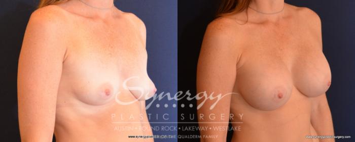 Before & After Breast Augmentation Case 534 View #4 View in Austin, TX