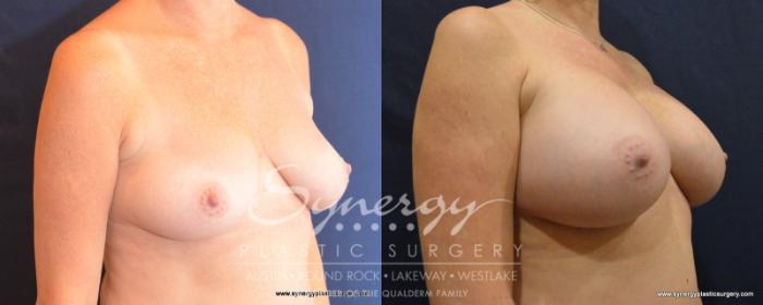 Before & After Breast Augmentation Case 535 View #2 View in Austin, TX