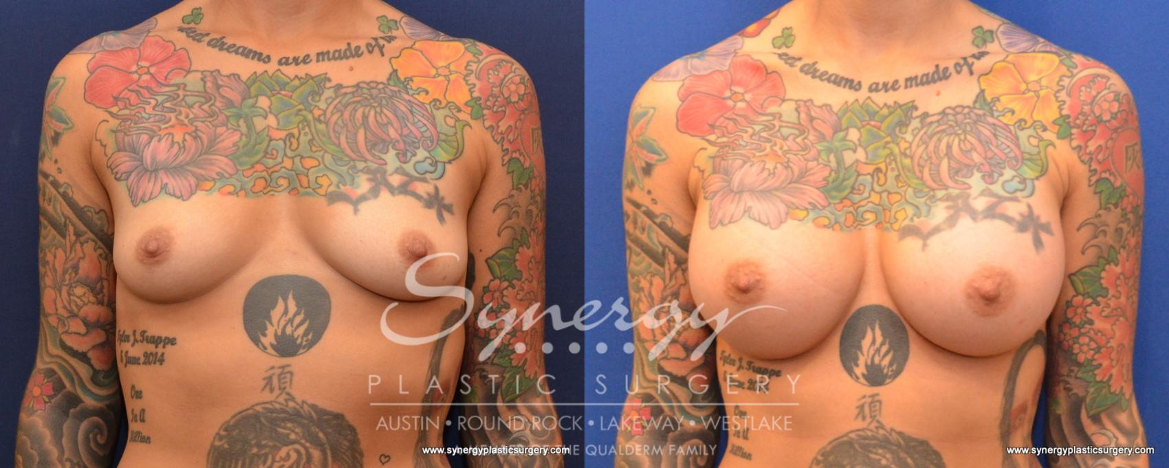 Before & After Breast Augmentation Case 539 View #1 View in Austin, TX