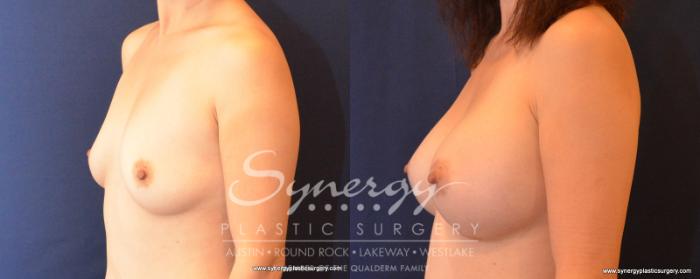 Before & After Breast Augmentation Case 544 View #2 View in Austin, TX
