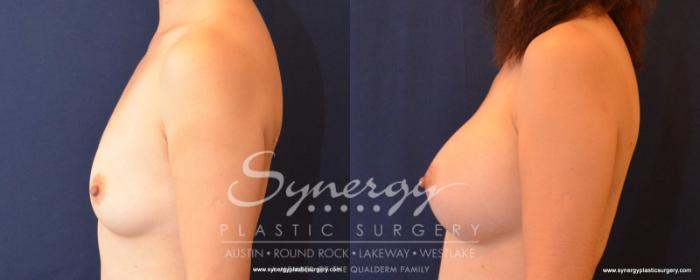 Before & After Breast Augmentation Case 544 View #3 View in Austin, TX