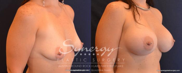 Before & After Breast Augmentation Case 545 View #2 View in Austin, TX