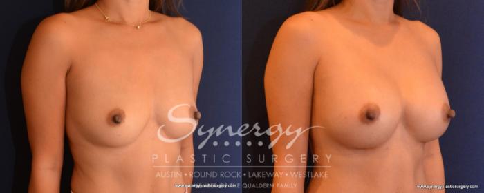 Before & After  Case 546 View #4 View in Austin, TX