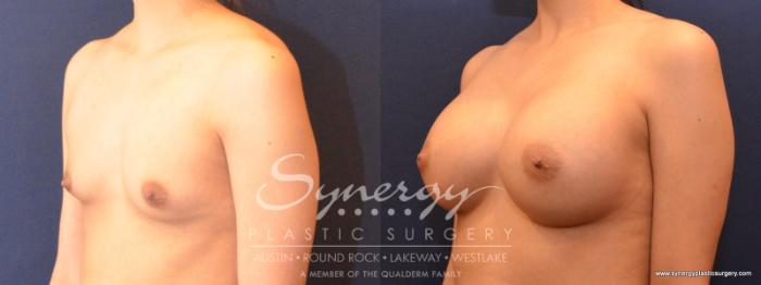 Before & After Breast Augmentation Case 549 View #2 View in Austin, TX