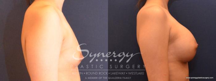 Before & After Breast Augmentation Case 549 View #4 View in Austin, TX