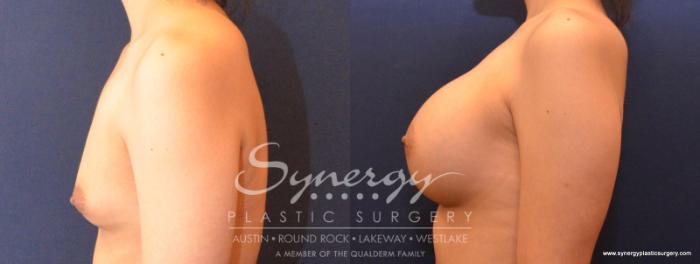 Before & After Breast Augmentation Case 549 View #5 View in Austin, TX
