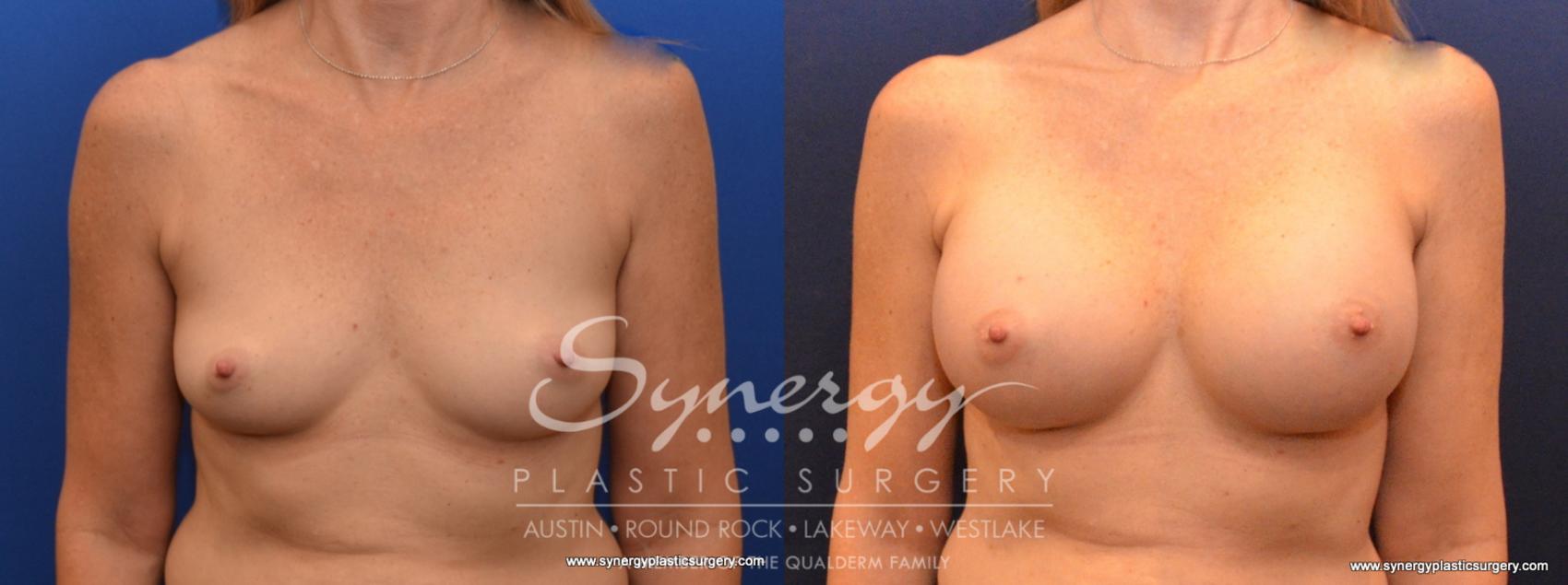 Before & After Breast Augmentation Case 552 View #1 View in Austin, TX