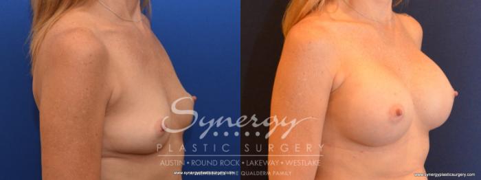 Before & After Breast Augmentation Case 552 View #2 View in Austin, TX