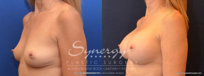 Before & After Breast Augmentation Case 552 View #4 View in Austin, TX