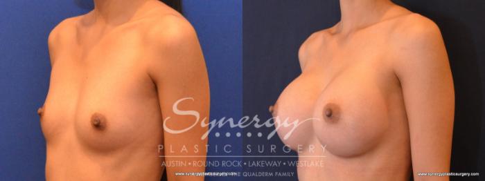 Before & After Breast Augmentation Case 553 View #2 View in Austin, TX