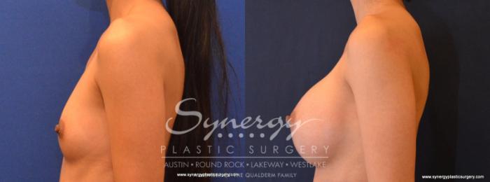Before & After Breast Augmentation Case 553 View #3 View in Austin, TX