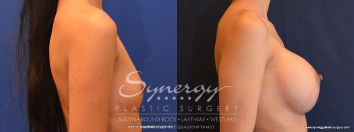 Before & After Breast Augmentation Case 553 View #5 View in Austin, TX