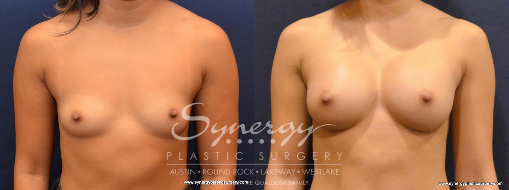 Before & After Breast Augmentation Case 554 View #1 View in Austin, TX